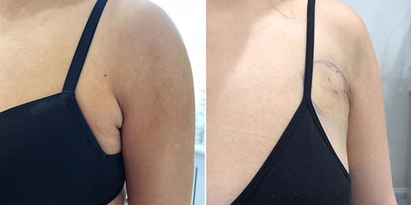 Before and after f-a-b-lipo surgery by Dr. Dana Khuthaila, plastic surgeon in New York City — patient 3