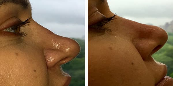 Before and after injectables surgery by Dr. Dana Khuthaila, plastic surgeon in New York City — patient 3
