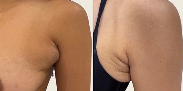 Before and after f-a-b-lipo surgery by Dr. Dana Khuthaila, plastic surgeon in New York City — patient 1