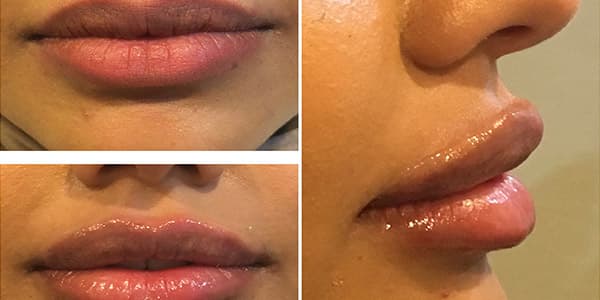 Before and after injectables surgery by Dr. Dana Khuthaila, plastic surgeon in New York City — patient 1