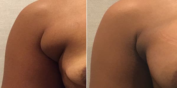 Before and after f-a-b-lipo surgery by Dr. Dana Khuthaila, plastic surgeon in New York City — patient 2