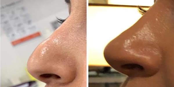 Before and after injectables surgery by Dr. Dana Khuthaila, plastic surgeon in New York City — patient 2