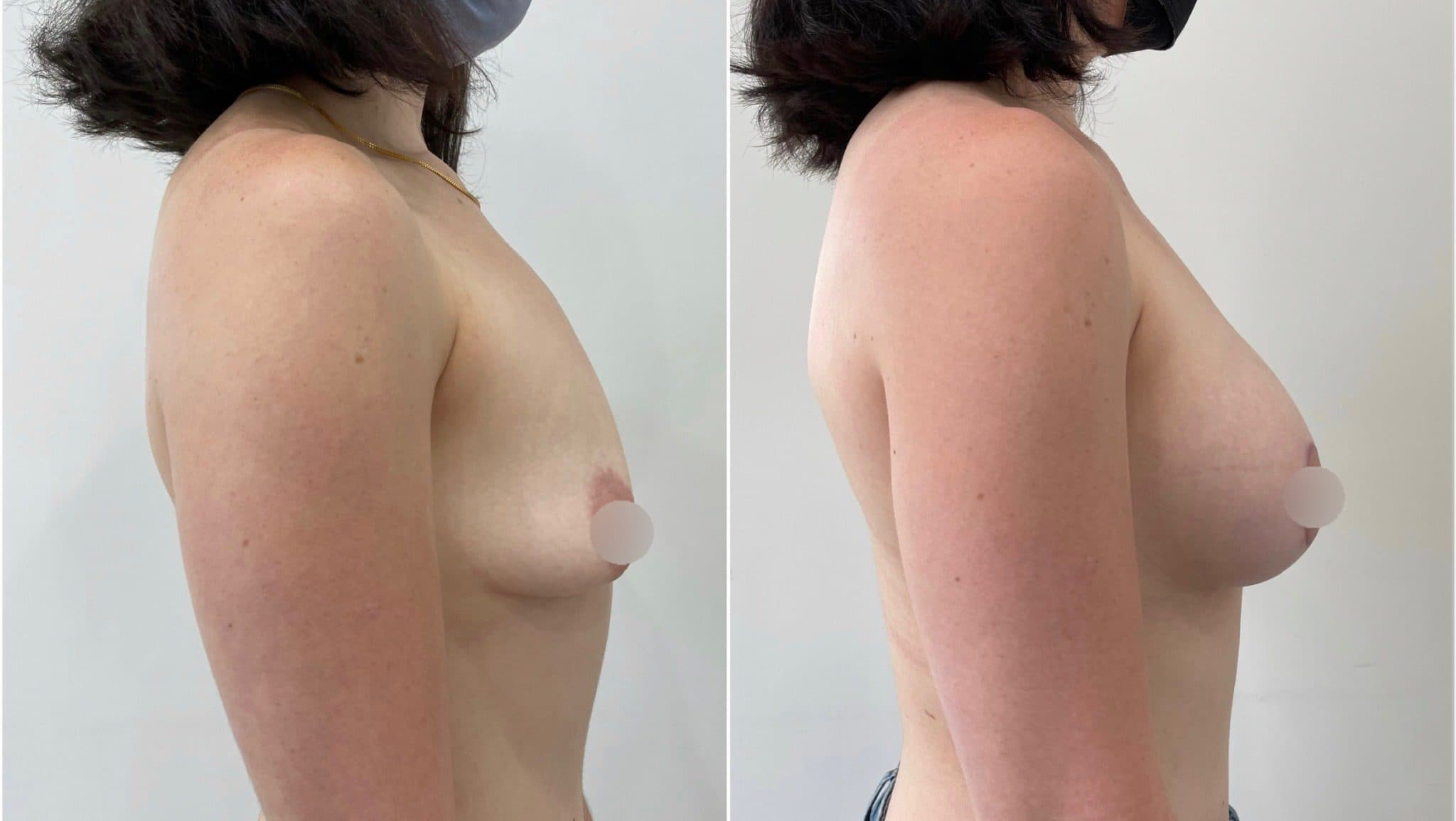 Before and after breast surgery by Dr. Dana Khuthaila, plastic surgeon in New York City — patient 87