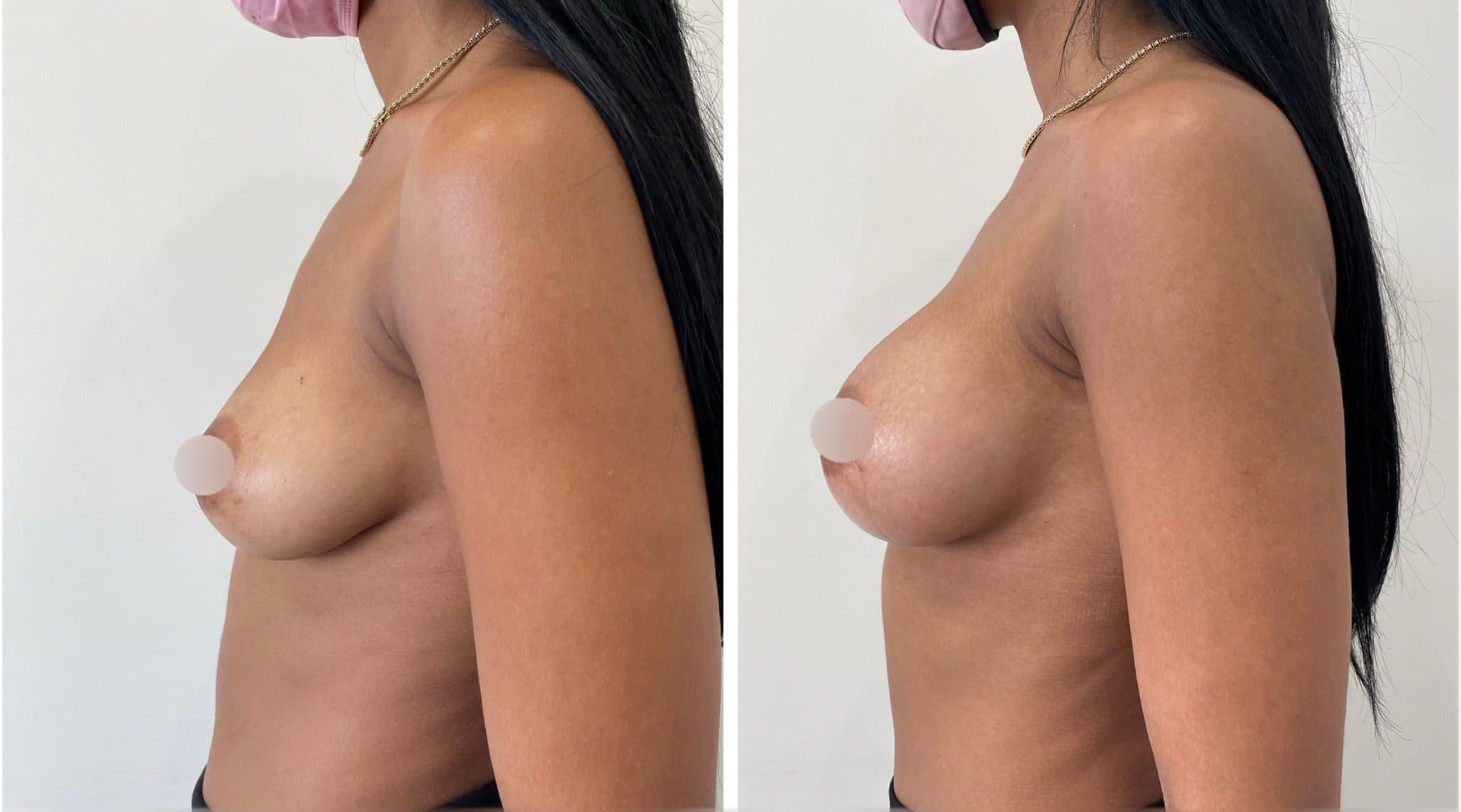 Before and after breast surgery by Dr. Dana Khuthaila, plastic surgeon in New York City — patient 81