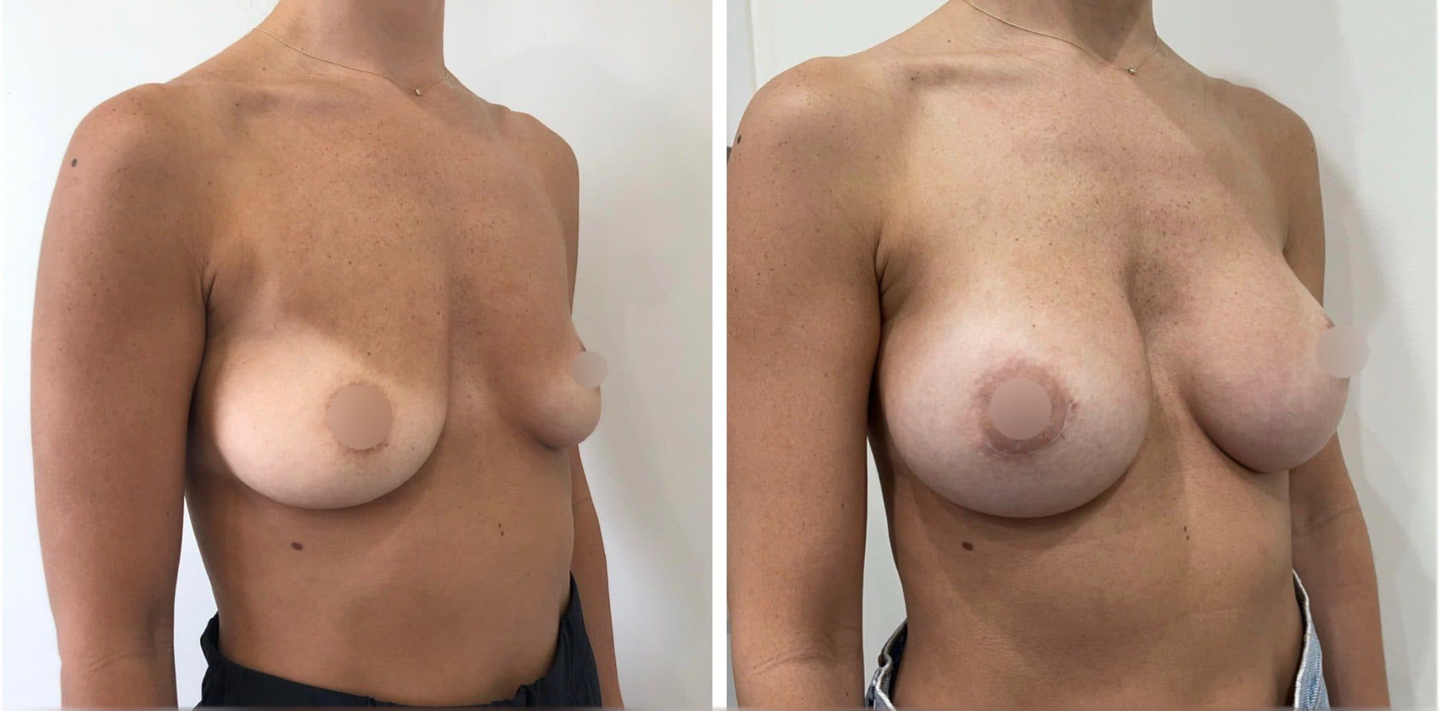 Before and after breast surgery by Dr. Dana Khuthaila, plastic surgeon in New York City — patient 82