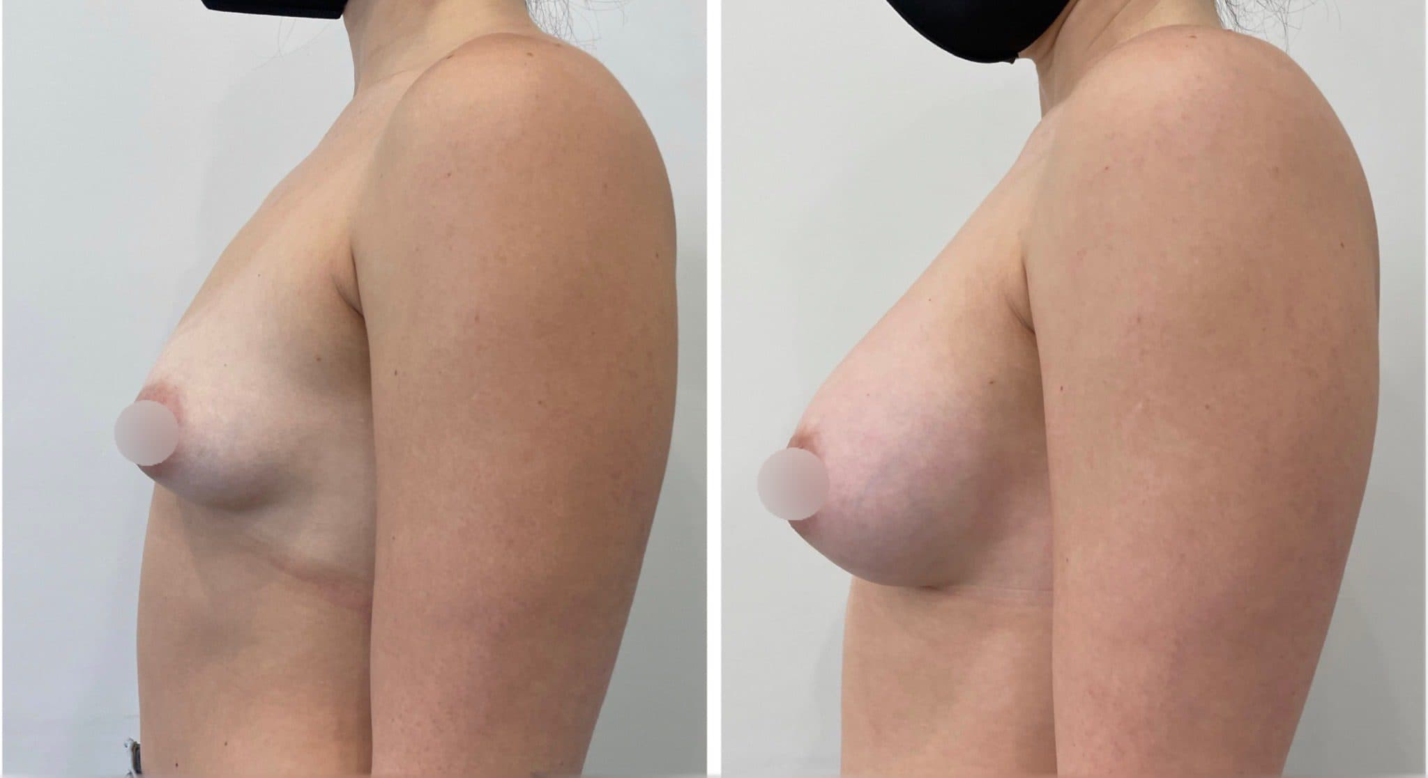 Before and after breast surgery by Dr. Dana Khuthaila, plastic surgeon in New York City — patient 94