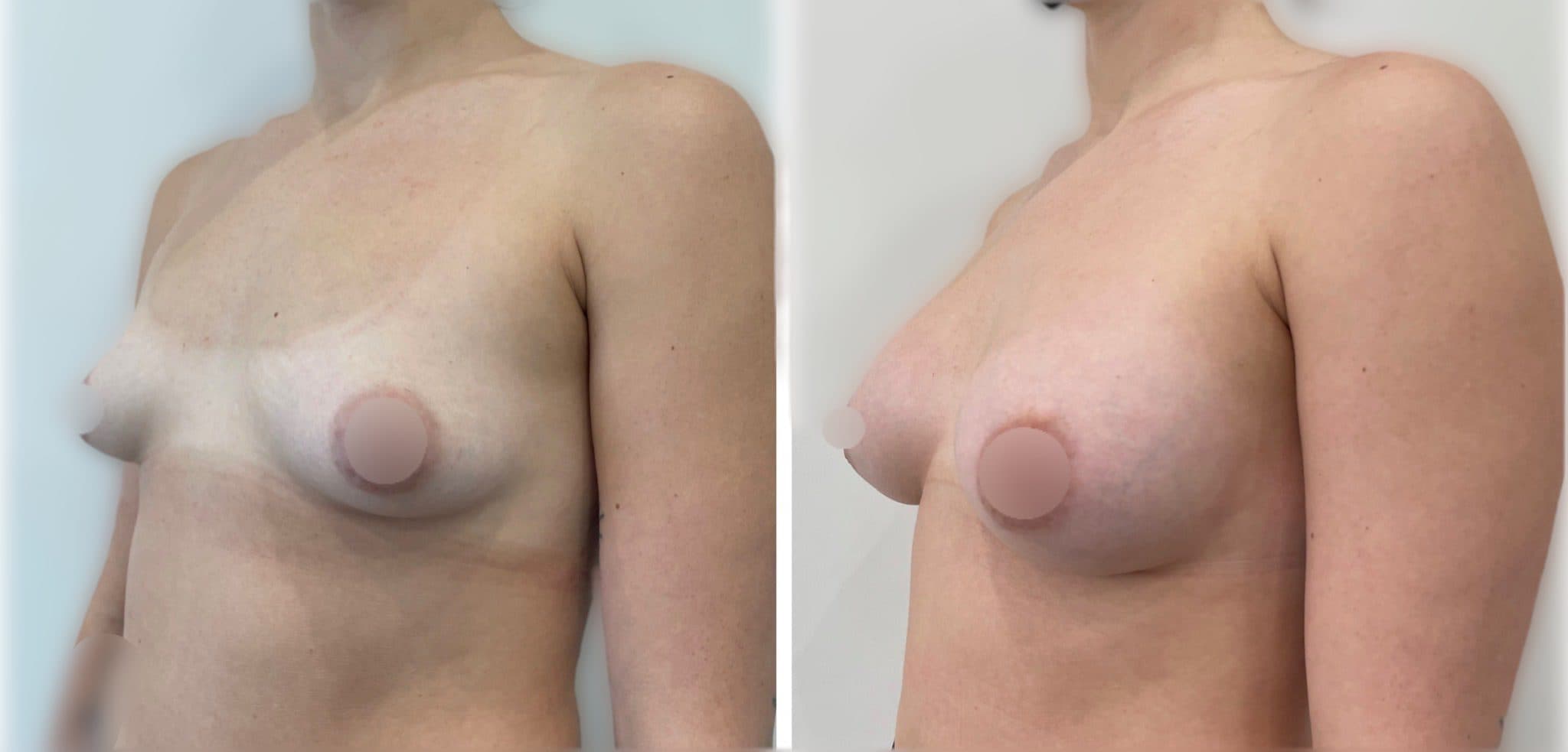 Before and after breast surgery by Dr. Dana Khuthaila, plastic surgeon in New York City — patient 89