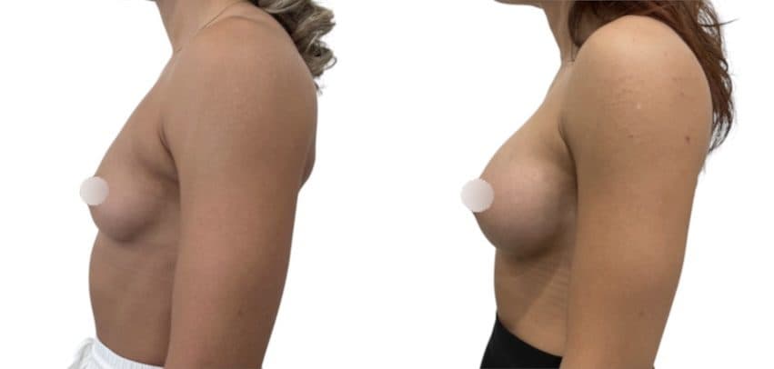 Before and after breast surgery by Dr. Dana Khuthaila, plastic surgeon in New York City — patient 96