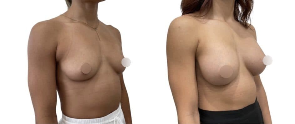 Before and after breast surgery by Dr. Dana Khuthaila, plastic surgeon in New York City — patient 95