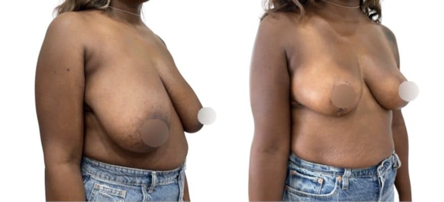 Before and after breast surgery by Dr. Dana Khuthaila, plastic surgeon in New York City — patient 23