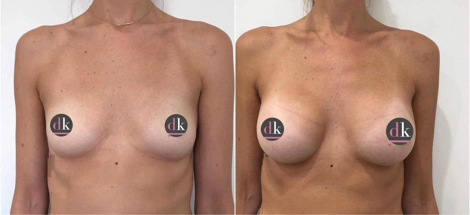Before and after breast surgery by Dr. Dana Khuthaila, plastic surgeon in New York City — patient 61