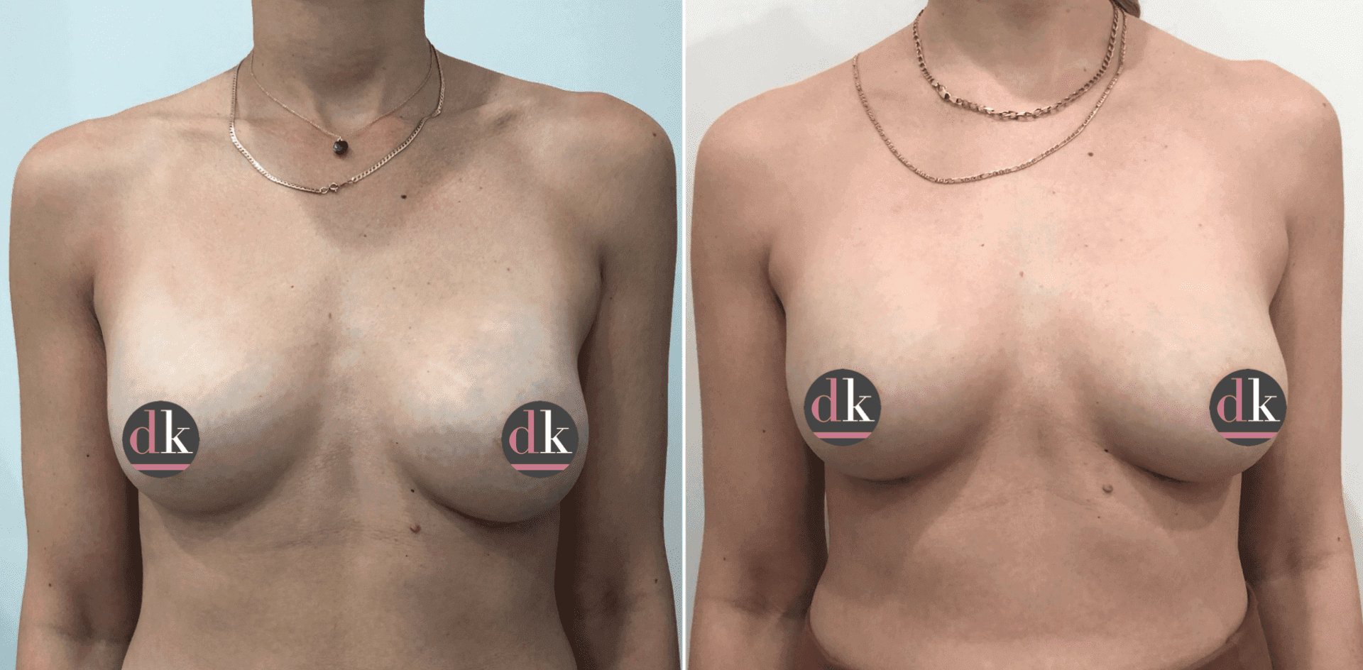 Before and after breast surgery by Dr. Dana Khuthaila, plastic surgeon in New York City — patient 63