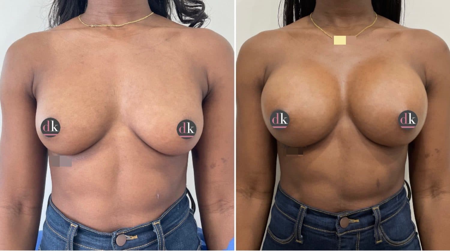 Before and after breast surgery by Dr. Dana Khuthaila, plastic surgeon in New York City — patient 27