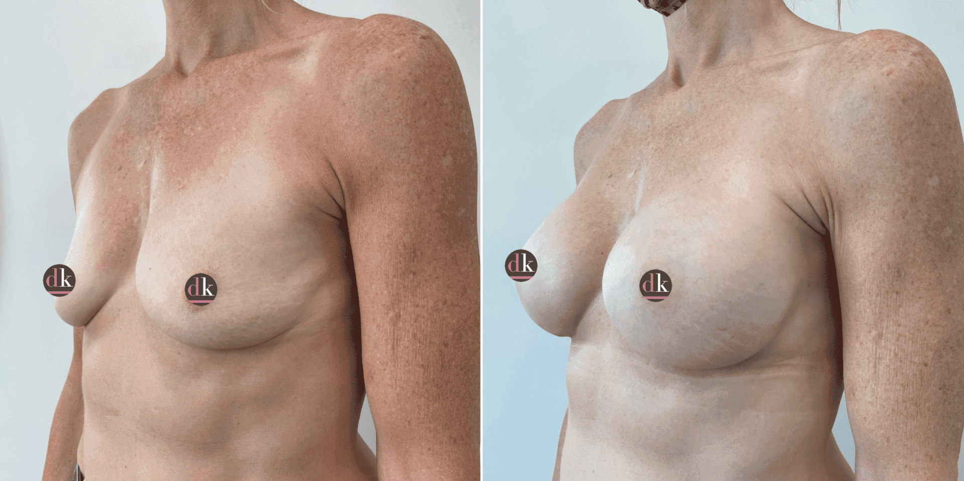 Before and after breast surgery by Dr. Dana Khuthaila, plastic surgeon in New York City — patient 52