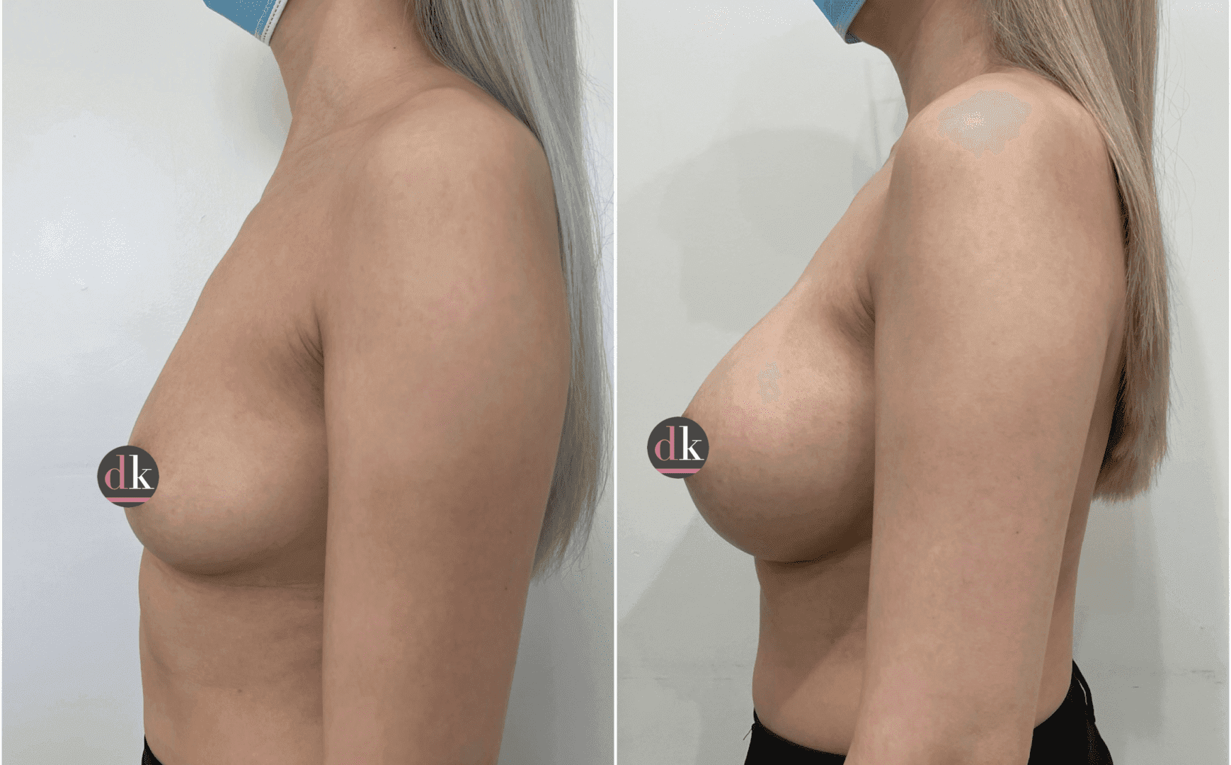 Before and after breast surgery by Dr. Dana Khuthaila, plastic surgeon in New York City — patient 44