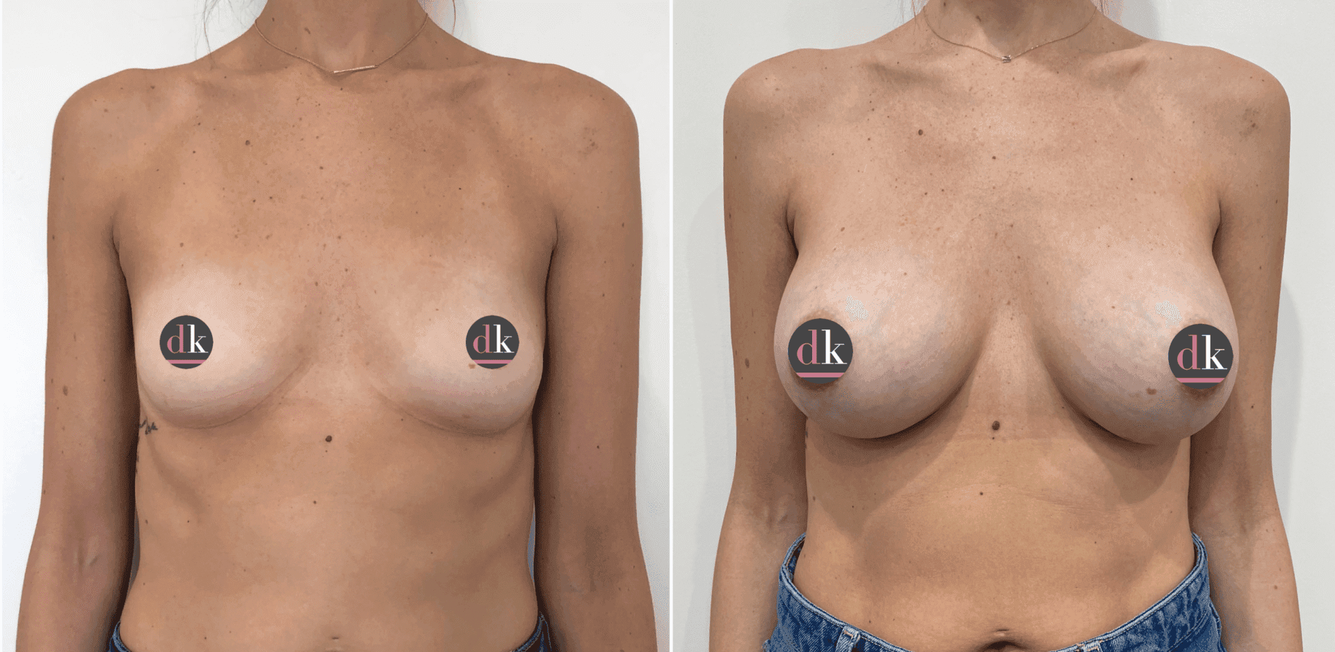 Before and after breast surgery by Dr. Dana Khuthaila, plastic surgeon in New York City — patient 54