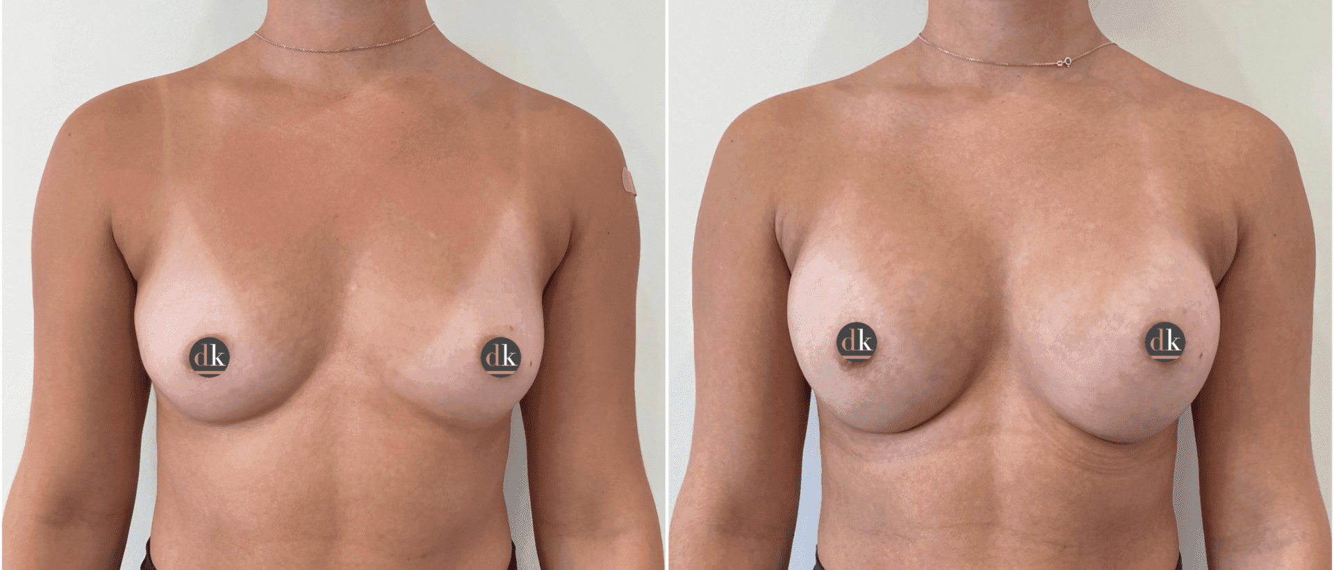 Before and after breast surgery by Dr. Dana Khuthaila, plastic surgeon in New York City — patient 46