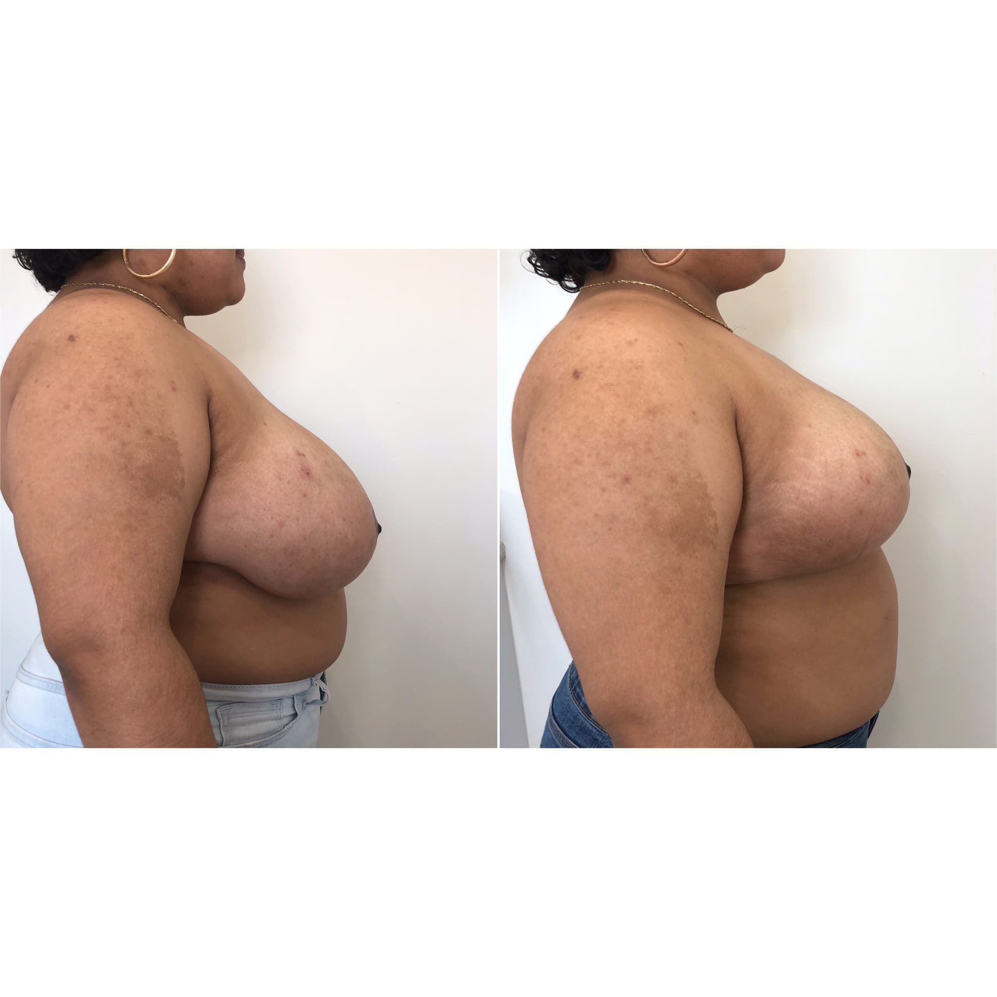Before and after breast surgery by Dr. Dana Khuthaila, plastic surgeon in New York City — patient 19