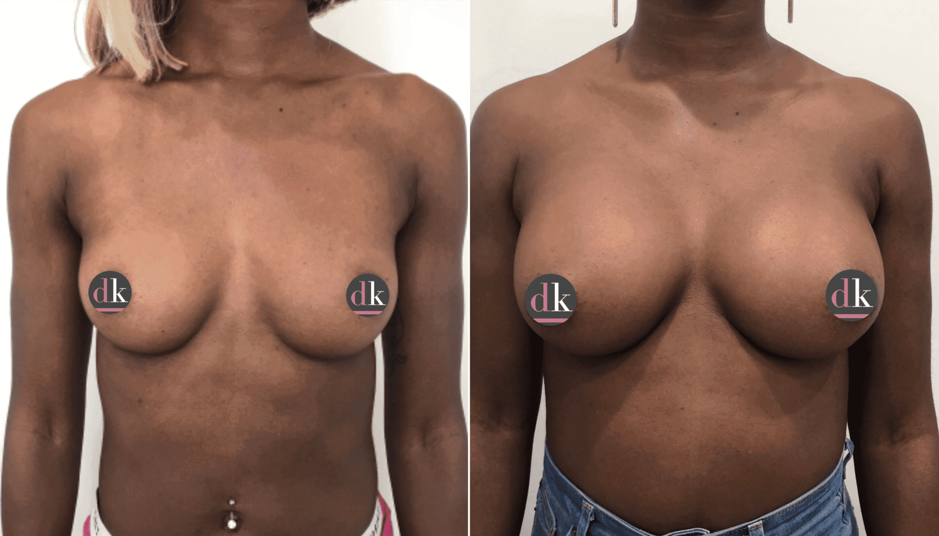 Before and after breast surgery by Dr. Dana Khuthaila, plastic surgeon in New York City — patient 56