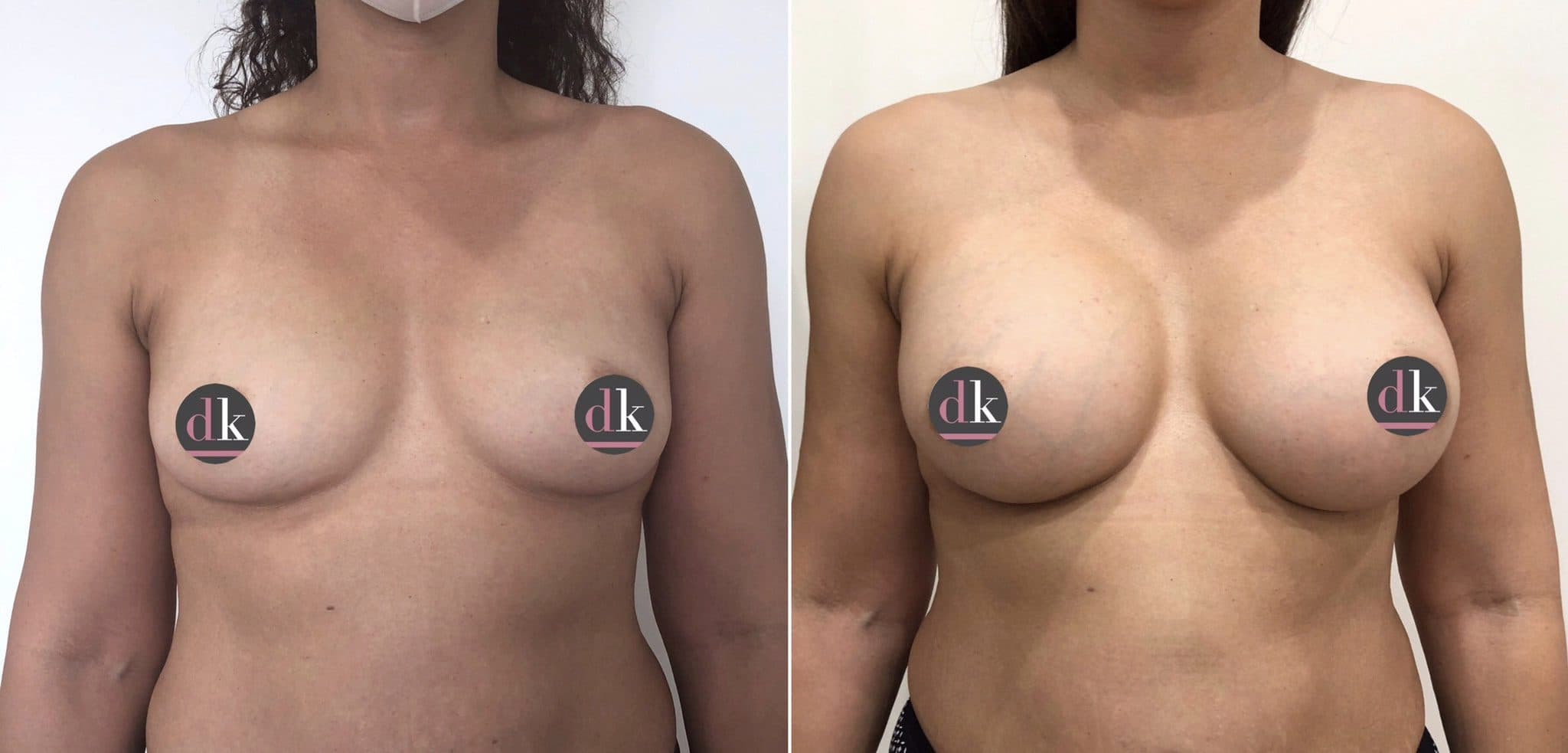 Before and after breast surgery by Dr. Dana Khuthaila, plastic surgeon in New York City — patient 51