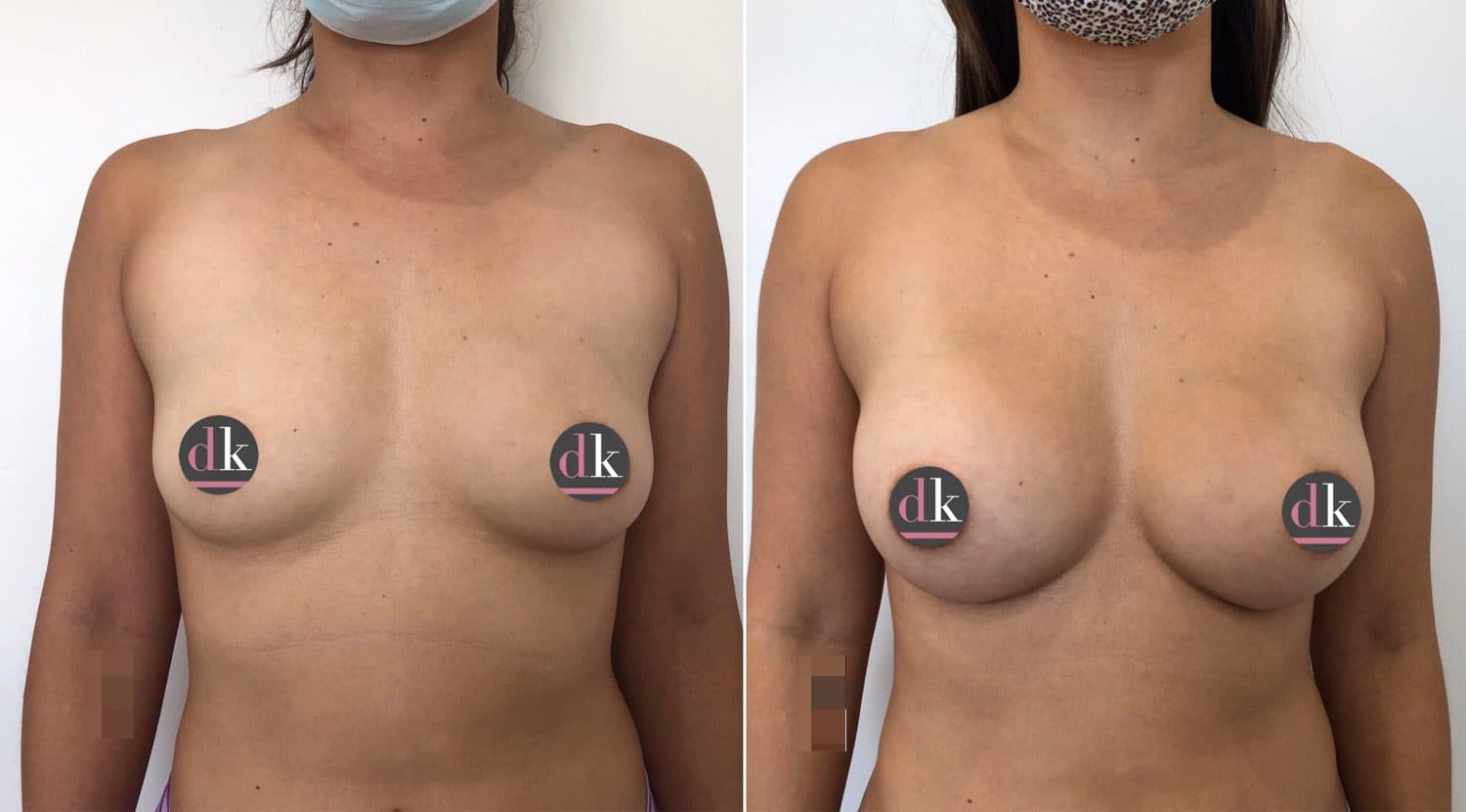 Before and after breast surgery by Dr. Dana Khuthaila, plastic surgeon in New York City — patient 55