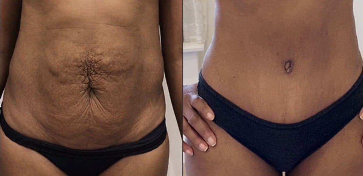 Before and after body surgery by Dr. Dana Khuthaila, plastic surgeon in New York City — patient 2
