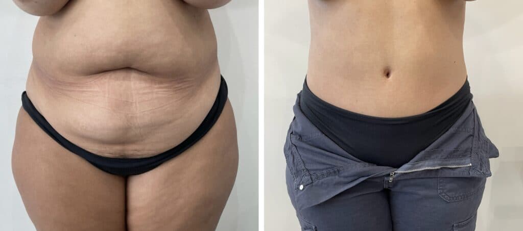 Before and after body surgery by Dr. Dana Khuthaila, plastic surgeon in New York City — patient 3