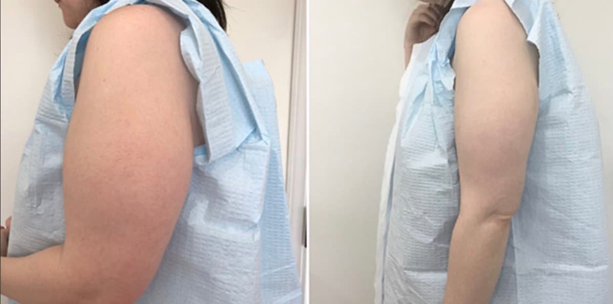 Before and after body surgery by Dr. Dana Khuthaila, plastic surgeon in New York City — patient 35