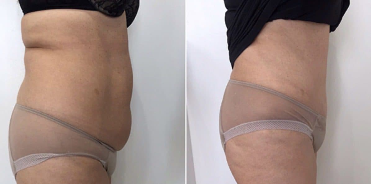 Before and after body surgery by Dr. Dana Khuthaila, plastic surgeon in New York City — patient 36