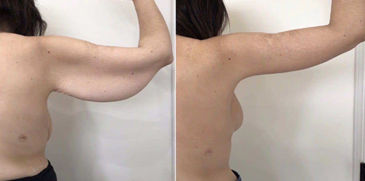 Before and after body surgery by Dr. Dana Khuthaila, plastic surgeon in New York City — patient 46