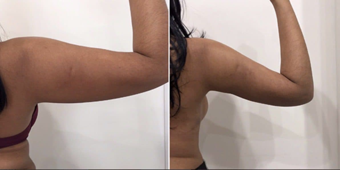 Before and after body surgery by Dr. Dana Khuthaila, plastic surgeon in New York City — patient 47