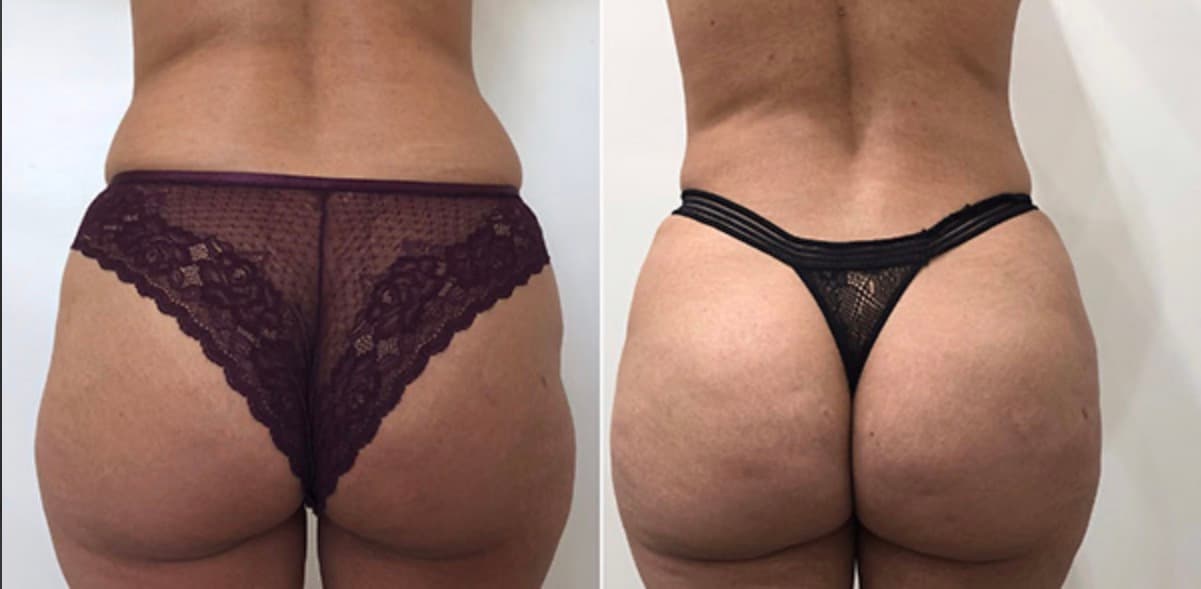 Before and after body surgery by Dr. Dana Khuthaila, plastic surgeon in New York City — patient 43