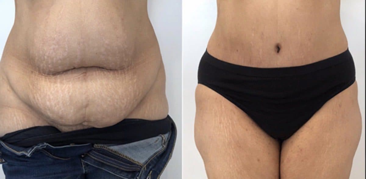 Before and after body surgery by Dr. Dana Khuthaila, plastic surgeon in New York City — patient 9