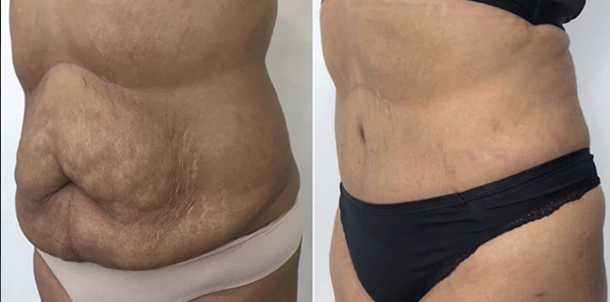 Before and after body surgery by Dr. Dana Khuthaila, plastic surgeon in New York City — patient 13