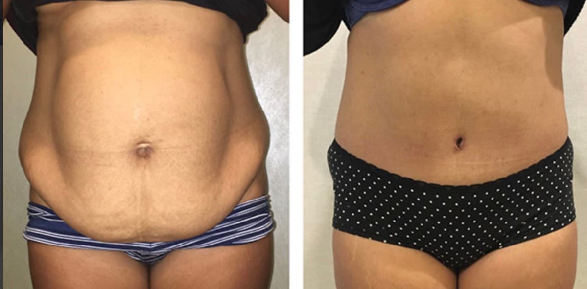 Before and after body surgery by Dr. Dana Khuthaila, plastic surgeon in New York City — patient 7