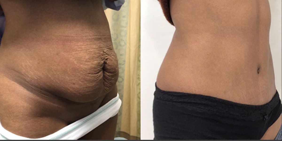 Before and after body surgery by Dr. Dana Khuthaila, plastic surgeon in New York City — patient 11