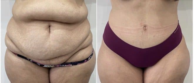 Before and after body surgery by Dr. Dana Khuthaila, plastic surgeon in New York City — patient 20