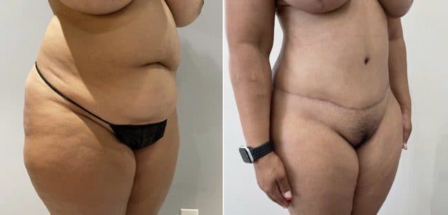 Before and after body surgery by Dr. Dana Khuthaila, plastic surgeon in New York City — patient 26