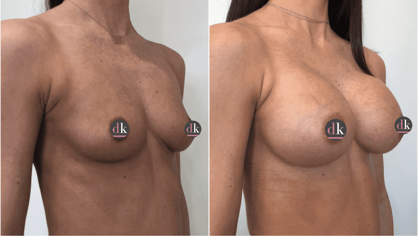Before and after breast surgery by Dr. Dana Khuthaila, plastic surgeon in New York City — patient 33
