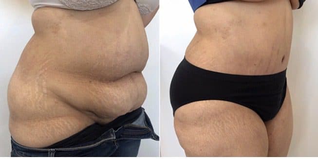 Before and after body surgery by Dr. Dana Khuthaila, plastic surgeon in New York City — patient 1