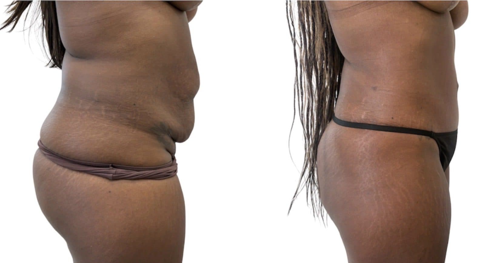 Before and after body surgery by Dr. Dana Khuthaila, plastic surgeon in New York City — patient 27