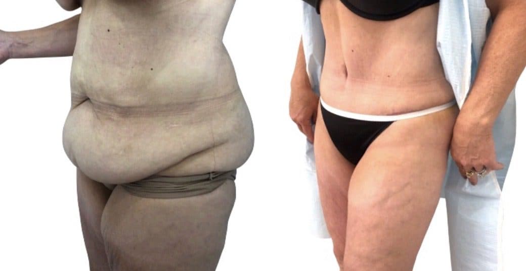 Before and after body surgery by Dr. Dana Khuthaila, plastic surgeon in New York City — patient 29