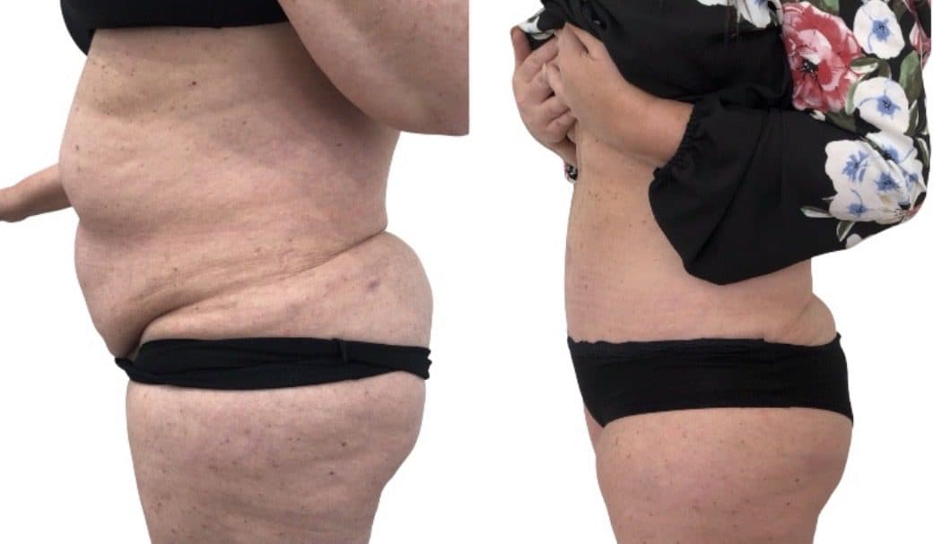 Before and after body surgery by Dr. Dana Khuthaila, plastic surgeon in New York City — patient 33