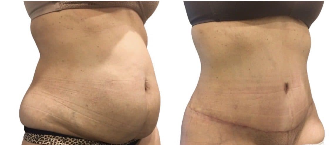 Before and after body surgery by Dr. Dana Khuthaila, plastic surgeon in New York City — patient 12
