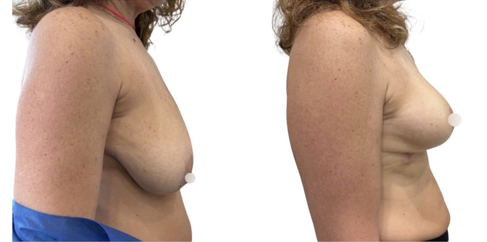 Before and after breast surgery by Dr. Dana Khuthaila, plastic surgeon in New York City — patient 21