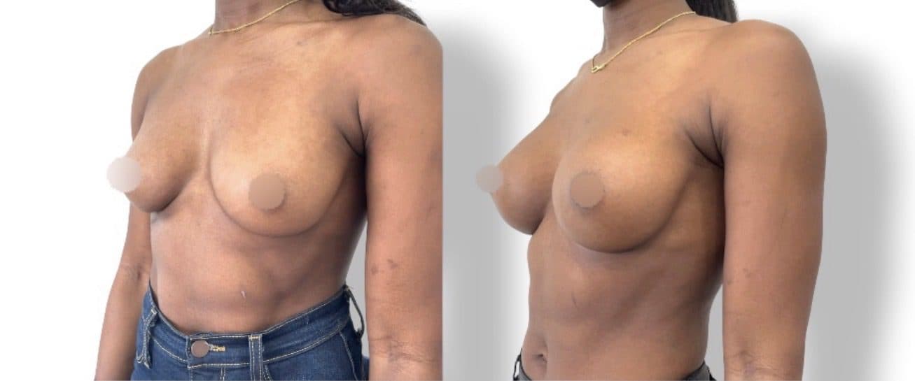 Before and after breast surgery by Dr. Dana Khuthaila, plastic surgeon in New York City — patient 77