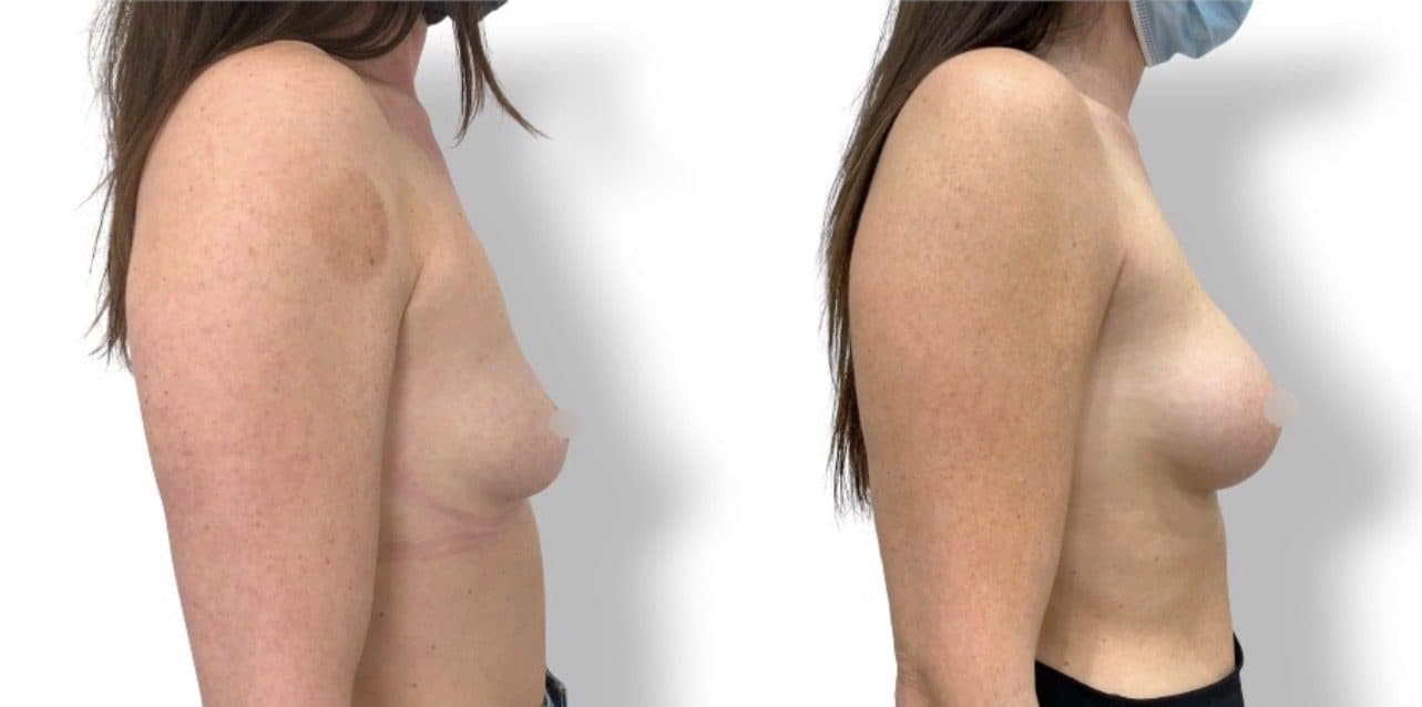 Before and after breast surgery by Dr. Dana Khuthaila, plastic surgeon in New York City — patient 72