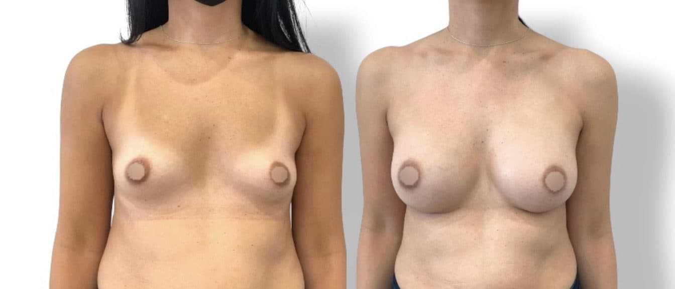Before and after breast surgery by Dr. Dana Khuthaila, plastic surgeon in New York City — patient 78