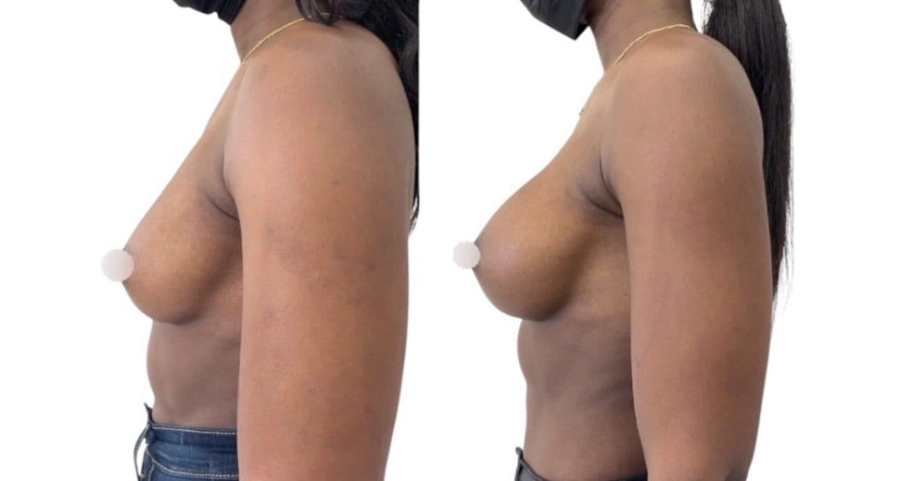 Before and after breast surgery by Dr. Dana Khuthaila, plastic surgeon in New York City — patient 80