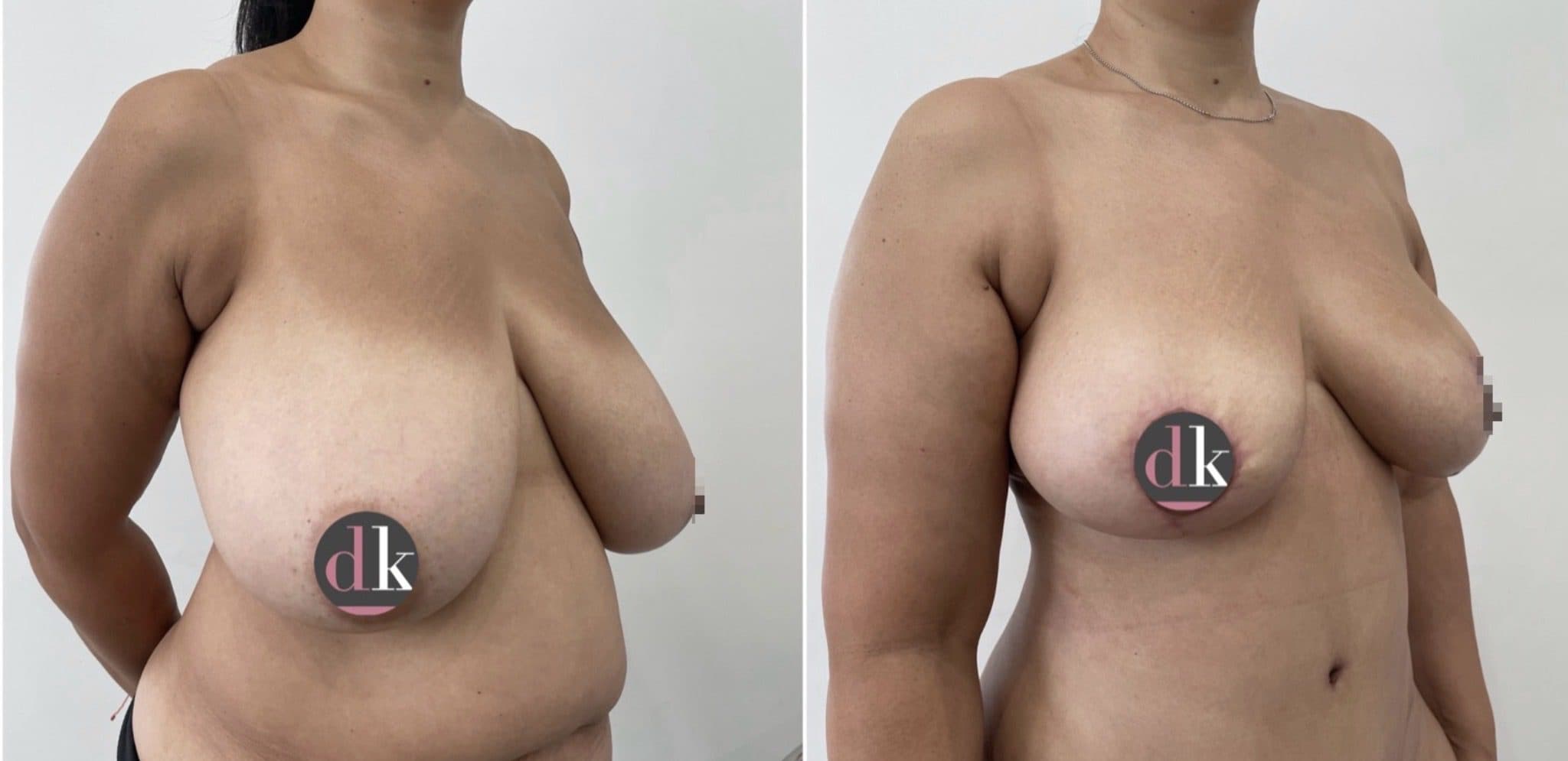 Before and after breast surgery by Dr. Dana Khuthaila, plastic surgeon in New York City — patient 20
